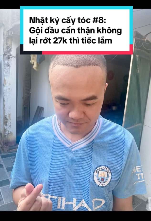 Sơn Arsenal, ngày 8 sau cấy tóc