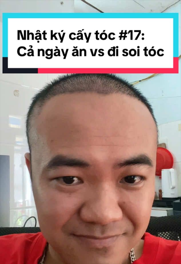 Ngày 17 sau cấy tóc, cả ngày soi tóc