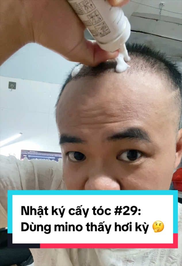 Tóc ngày 29 sau cấy: tóc con bắt đầu rơi