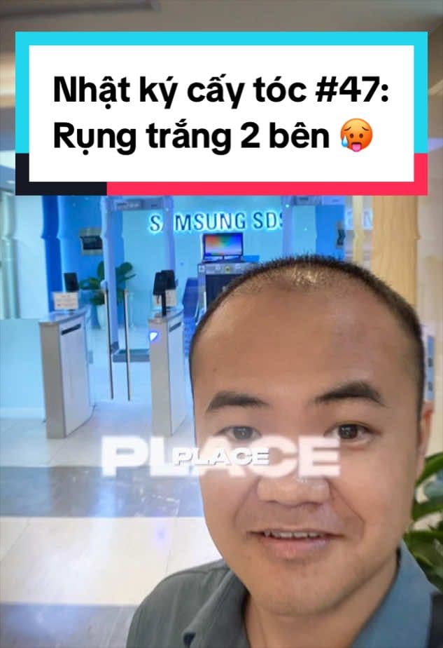 Ngày 47 sau cấy tóc, rụng trắng hai bên