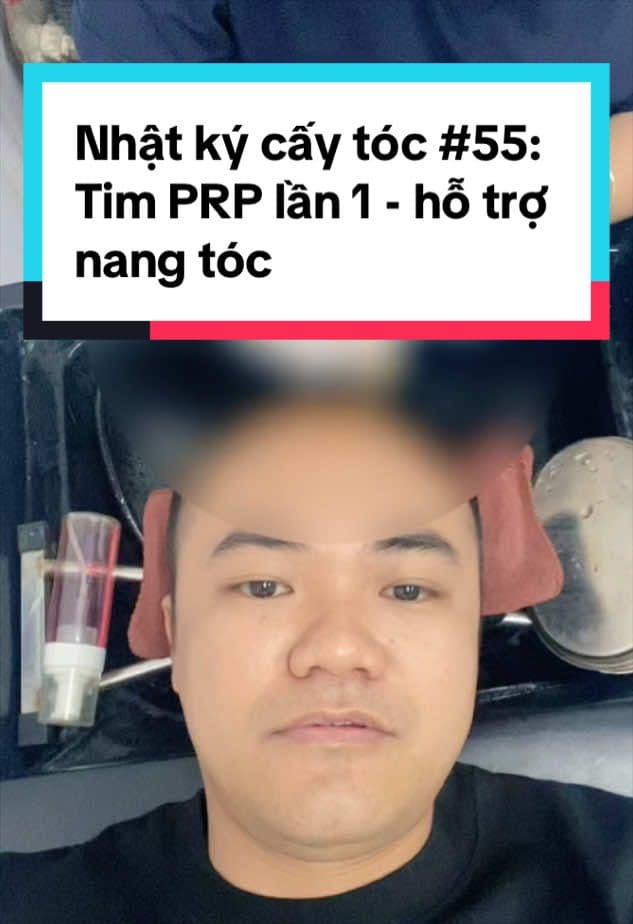 Sơn Arsenal, ngày 55 sau cấy tóc