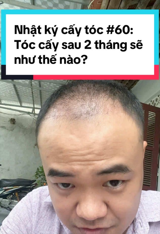Tóc ngày 60 sau cấy: rụng sốc, thưa nhất