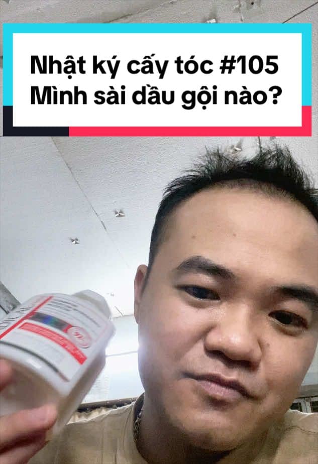 Tóc ngày 105 sau cấy: mọc rõ hơn hẳn