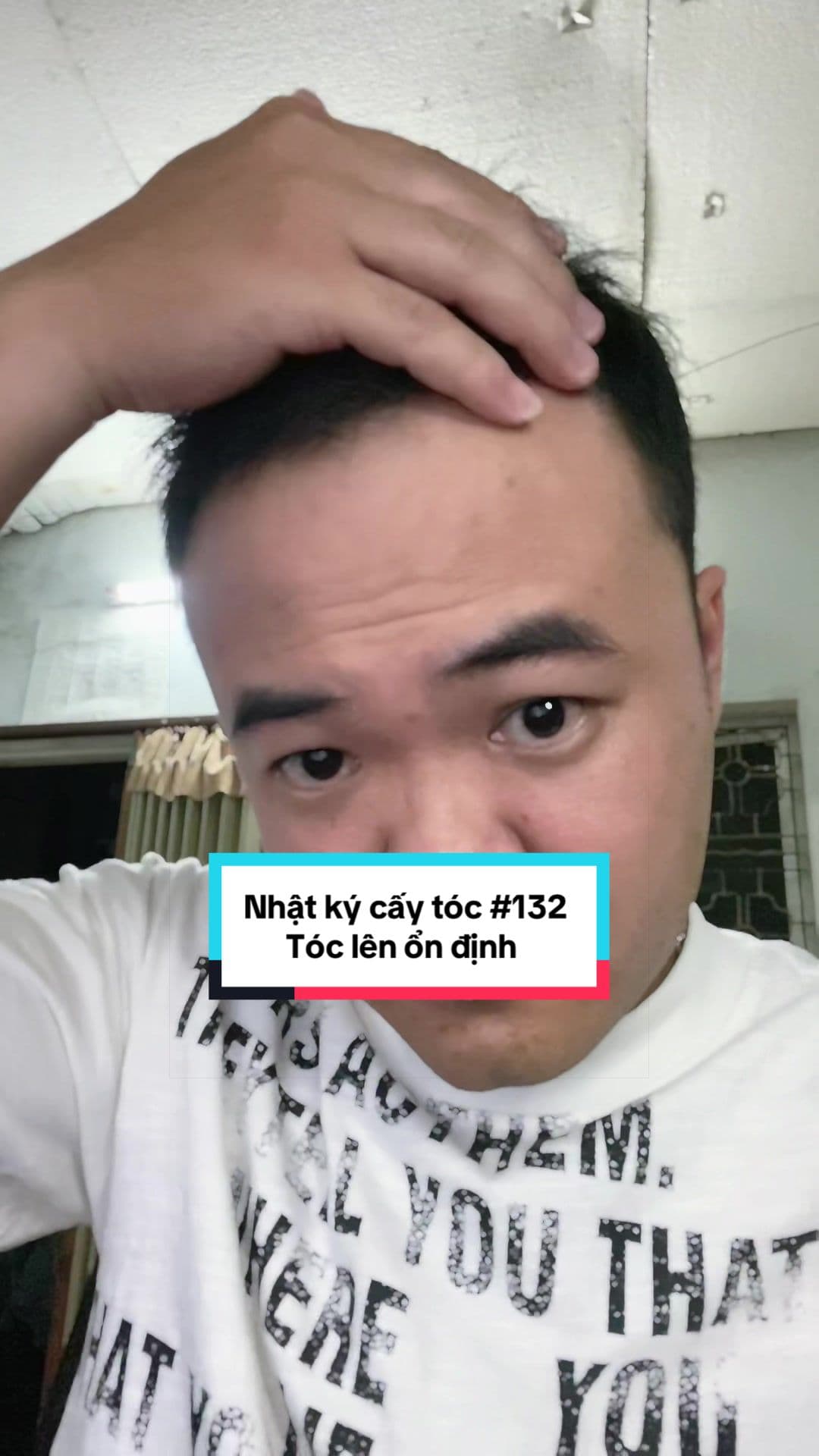 Tóc ngày 132 sau cấy: tóc lên ổn định