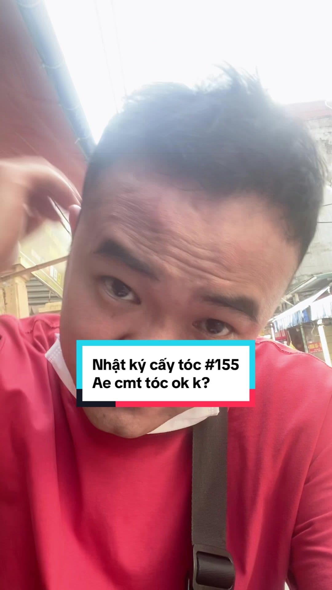 Sơn Arsenal, ngày 155 sau cấy tóc
