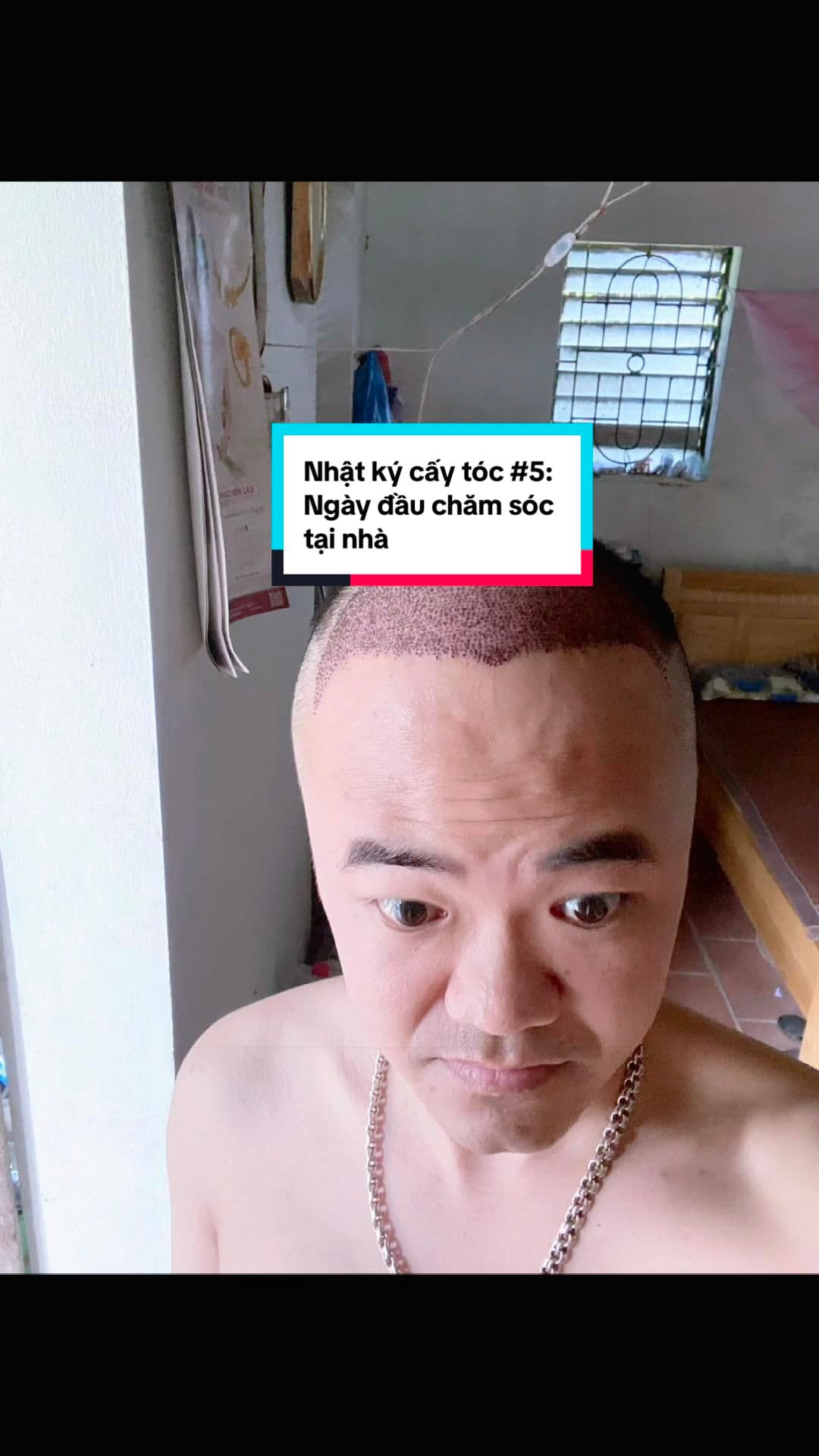 Ngày 5 sau cấy (02/05/2026): Ngày đầu tự chăm sóc tại nhà