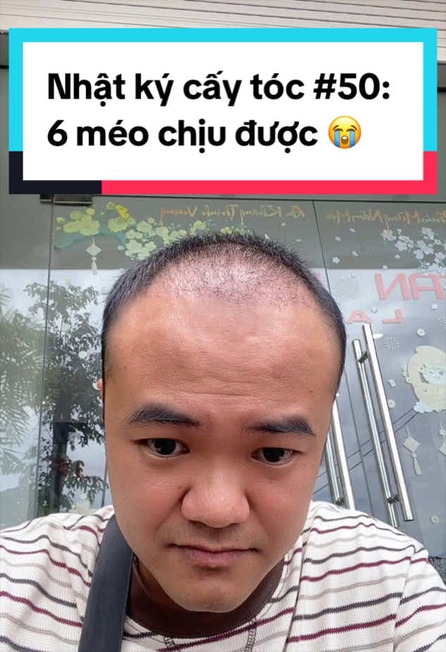 Ngày 50 sau cấy tóc: 6 méo chịu được