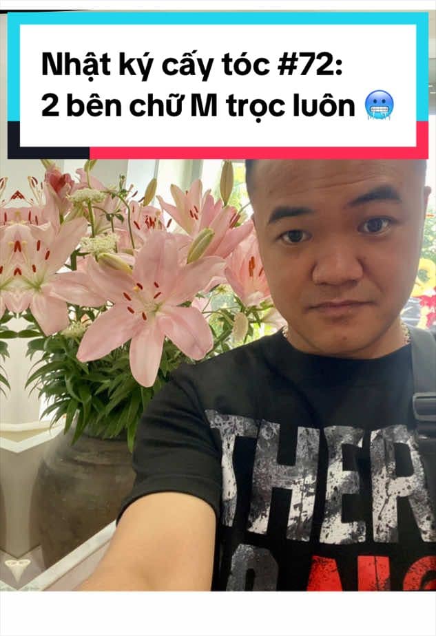 Ngày 72 sau cấy tóc: 2 bên chữ M trọc luôn