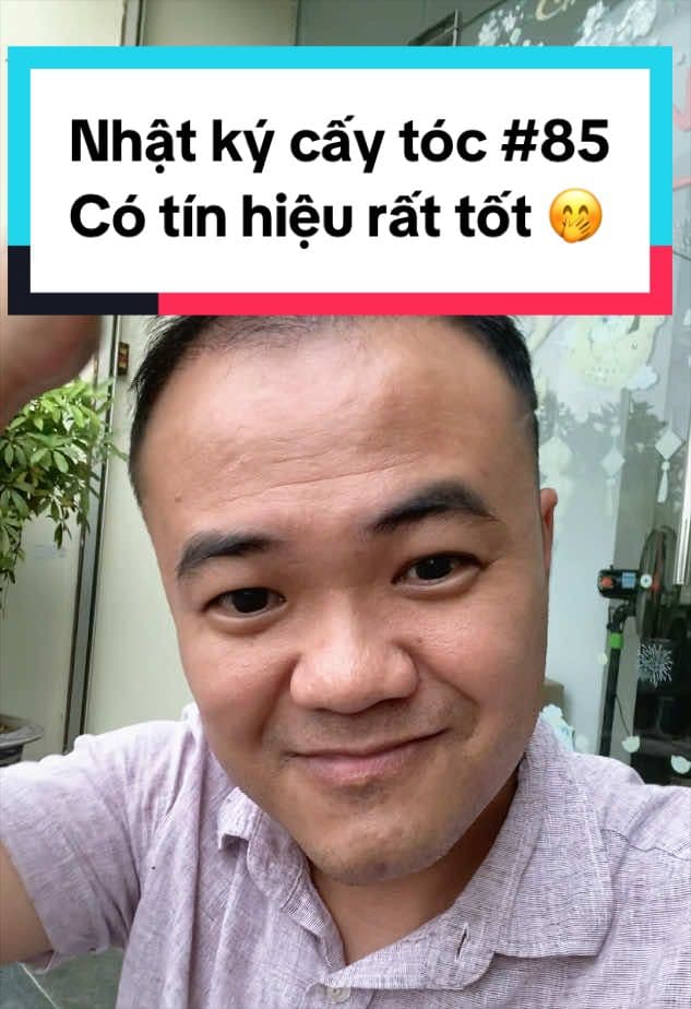 Ngày 85 sau cấy tóc: Có tín hiệu rất tốt